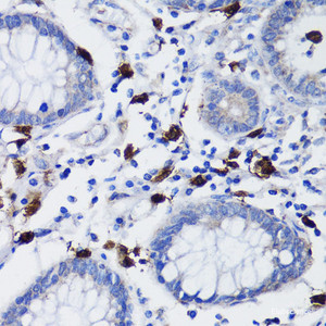 Immunohistochemistry of paraffin-embedded Human colon carcinoma using TET3 Polyclonal Antibody at dilution of 1:200 (40x lens) .