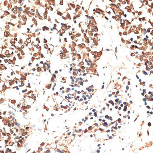Immunohistochemistry of paraffin-embedded Human lung cancer using MCM5 Polyclonal Antibody at dilution of 1:100 (40x lens) .