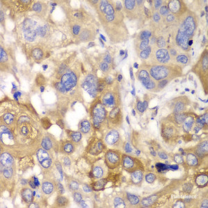 Immunohistochemistry of paraffin-embedded Human esophageal cancer using PPP1CB Polyclonal Antibody at dilution of 1:100 (40x lens) .