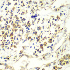 Immunohistochemistry of paraffin-embedded Human liver cancer using UPF1 Polyclonal Antibody at dilution of 1:100 (40x lens) .