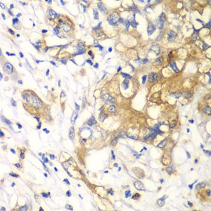 Immunohistochemistry of paraffin-embedded Human liver cancer using KLK10 Polyclonal Antibody at dilution of 1:100 (40x lens) .