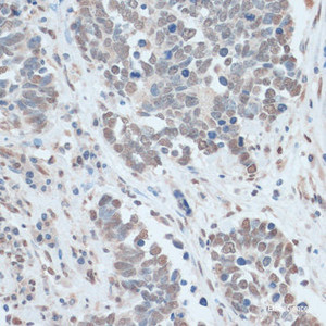 Immunohistochemistry of paraffin-embedded Human lung cancer using ZNF707 Polyclonal Antibody at dilution of 1:100 (40x lens) .