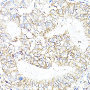 Immunohistochemistry of paraffin-embedded Human lung cancer using ATP1B1 Polyclonal Antibody at dilution of 1:100 (40x lens) .