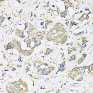 Immunohistochemistry of paraffin-embedded Human breast cancer using ATP2A3 Polyclonal Antibody at dilution of 1:100 (40x lens) .