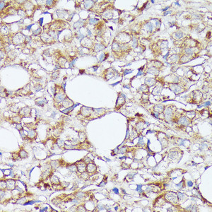 Immunohistochemistry of paraffin-embedded Human mammary cancer using SLC7A2 Polyclonal Antibody at dilution of 1:100 (40x lens) .