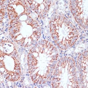 Immunohistochemistry of paraffin-embedded Human colon carcinoma using HIGD1A Polyclonal Antibody at dilution of 1:100 (40x lens) .