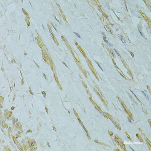 Immunohistochemistry of paraffin-embedded Human uterine cancer using IFT57 Polyclonal Antibody at dilution of 1:100 (40x lens) .