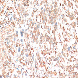 Immunohistochemistry of paraffin-embedded Human gastric cancer using CDH11 Polyclonal Antibody at dilution of 1:100 (40x lens) .