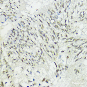 Immunohistochemistry of paraffin-embedded Human gastric cancer using ZEB1 Polyclonal Antibody at dilution of 1:200 (40x lens) .