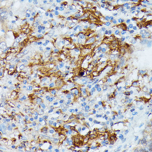 Immunohistochemistry of paraffin-embedded Human lung cancer using RNASE6 Polyclonal Antibody at dilution of 1:100 (40x lens) .