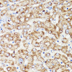 Immunohistochemistry of paraffin-embedded Human liver cancer using PRR11 Polyclonal Antibody at dilution of 1:100 (40x lens) .