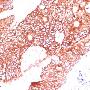 Immunohistochemistry of paraffin-embedded Human colon carcinoma using FAM98A Polyclonal Antibody at dilution of 1:100 (40x lens) .