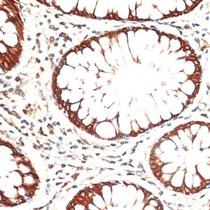 Immunohistochemistry of paraffin-embedded Human colon carcinoma using KRT13 Polyclonal Antibody at dilution of 1:100 (40x lens) .