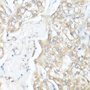 Immunohistochemistry of paraffin-embedded Human liver cancer using SMAD7 Polyclonal Antibody at dilution of 1:100 (40x lens) .
