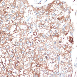 Immunohistochemistry of paraffin-embedded Human liver cancer using SLAMF7 Polyclonal Antibody at dilution of 1:100 (40x lens) .