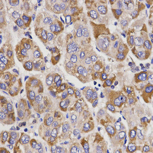 Immunohistochemistry of paraffin-embedded Human liver cancer using UGT1A9 Polyclonal Antibody at dilution of 1:200 (40x lens) .