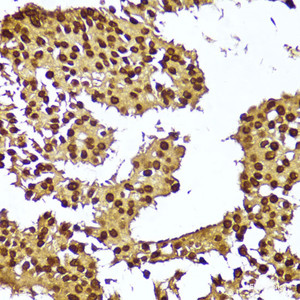 Immunohistochemistry of paraffin-embedded Human breast cancer using TERT Polyclonal Antibody at dilution of 1:100 (40x lens) .