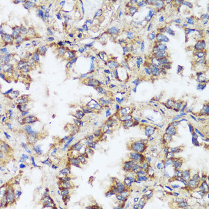 Immunohistochemistry of paraffin-embedded Human lung cancer using ERK1 / ERK2 Polyclonal Antibody at dilution of 1:200 (40x lens) .