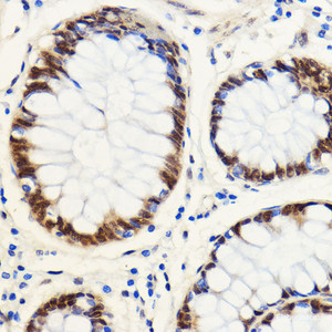 Immunohistochemistry of paraffin-embedded Human colon carcinoma using SNIP1 Polyclonal Antibody at dilution of 1:100 (40x lens) .