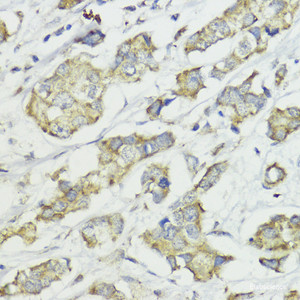 Immunohistochemistry of paraffin-embedded Human mammary cancer using CCNB1 Polyclonal Antibody at dilution of 1:100 (40x lens) .
