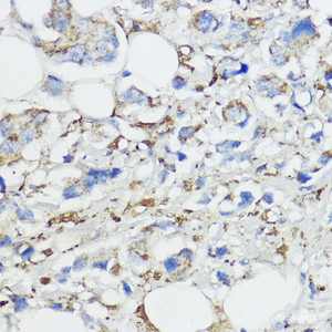 Immunohistochemistry of paraffin-embedded Human mammary cancer using FXN Polyclonal Antibody at dilution of 1:100 (40x lens) .