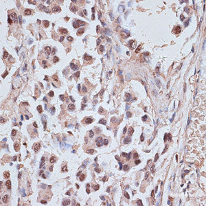 Immunohistochemistry of paraffin-embedded Human lung cancer using NR5A2 Polyclonal Antibody at dilution of 1:100 (40x lens) .