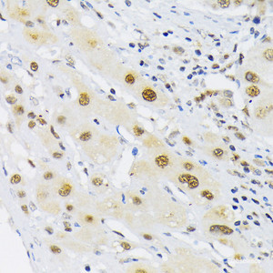 Immunohistochemistry of paraffin-embedded Human liver cancer using HIF1A Polyclonal Antibody at dilution of 1:200 (40x lens) .