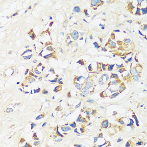 Immunohistochemistry of paraffin-embedded Human breast cancer using CADPS Polyclonal Antibody at dilution of 1:100 (40x lens) .
