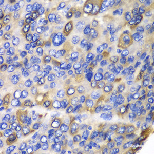 Immunohistochemistry of paraffin-embedded Human liver cancer using CES1 Polyclonal Antibody at dilution of 1:100 (40x lens) .