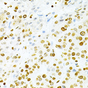 Immunohistochemistry of paraffin-embedded Human liver cancer using DKC1 Polyclonal Antibody at dilution of 1:200 (40x lens) .