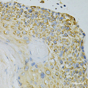 Immunohistochemistry of paraffin-embedded Human esophageal cancer using GPX4 Polyclonal Antibody at dilution of 1:200 (40x lens) .