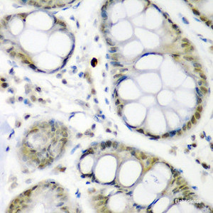 Immunohistochemistry of paraffin-embedded Human colon carcinoma using CDC27 Polyclonal Antibody at dilution of 1:200 (40x lens) .