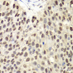 Immunohistochemistry of paraffin-embedded Human lung cancer using MCM6 Polyclonal Antibody at dilution of 1:100 (40x lens) .