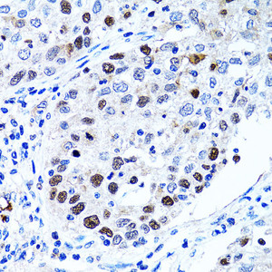 Immunohistochemistry of paraffin-embedded Human lung cancer using UHRF1 Polyclonal Antibody at dilution of 1:100 (40x lens) .