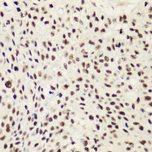 Immunohistochemistry of paraffin-embedded Human lung cancer using NELFE Polyclonal Antibody at dilution of 1:100 (40x lens) .