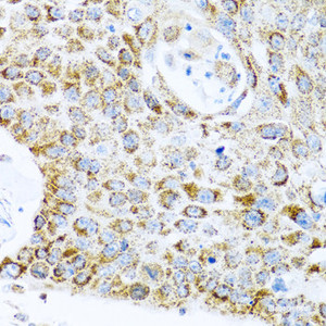 Immunohistochemistry of paraffin-embedded Human lung cancer using LRPPRC Polyclonal Antibody at dilution of 1:100 (40x lens) .