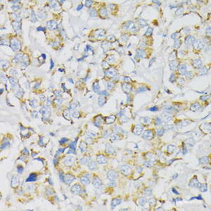 Immunohistochemistry of paraffin-embedded Human breast cancer using ATP5J Polyclonal Antibody at dilution of 1:100 (40x lens) .