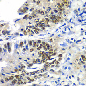 Immunohistochemistry of paraffin-embedded Human colon carcinoma using DACH1 Polyclonal Antibody at dilution of 1:100 (40x lens) .