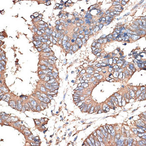 Immunohistochemistry of paraffin-embedded Human colon carcinoma using KRT81 Polyclonal Antibody at dilution of 1:100 (40x lens) .