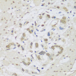 Immunohistochemistry of paraffin-embedded Human gastric cancer using DHX38 Polyclonal Antibody at dilution of 1:150 (40x lens) .