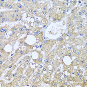 Immunohistochemistry of paraffin-embedded Human liver damage using TUBGCP3 Polyclonal Antibody at dilution of 1:100 (40x lens) .