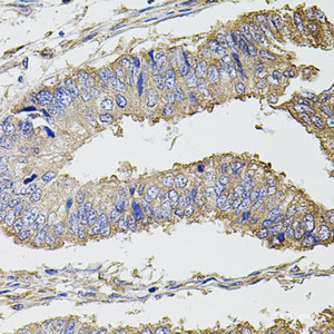 Immunohistochemistry of paraffin-embedded Human colon carcinoma using UBE2S Polyclonal Antibody at dilution of 1:100 (40x lens) .