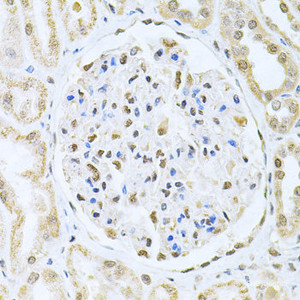 Immunohistochemistry of paraffin-embedded Human kidney cancer using CBFB Polyclonal Antibody at dilution of 1:200 (40x lens) .