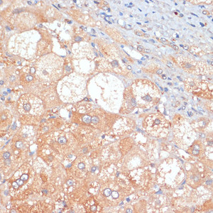 Immunohistochemistry of paraffin-embedded Human liver cancer using RIP3 Polyclonal Antibody at dilution of 1:100 (40x lens) .