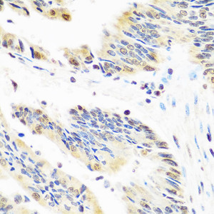 Immunohistochemistry of paraffin-embedded Human colon carcinoma using Snail Polyclonal Antibody at dilution of 1:100 (40x lens) .