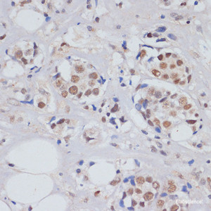 Immunohistochemistry of paraffin-embedded Human breast cancer using SKIV2L2 Polyclonal Antibody at dilution of 1:100 (40x lens) .