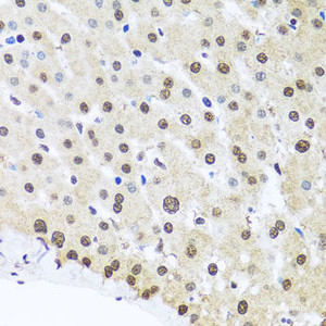 Immunohistochemistry of paraffin-embedded Human liver damage using FUBP1 Polyclonal Antibody at dilution of 1:100 (40x lens) .