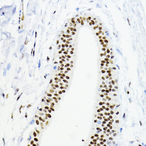 Immunohistochemistry of paraffin-embedded Human mammary cancer using ZEB1 Polyclonal Antibody at dilution of 1:200 (40x lens) .