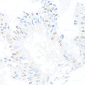 Immunohistochemistry of paraffin-embedded Human mammary cancer using CREM Polyclonal Antibody at dilution of 1:100 (40x lens) .