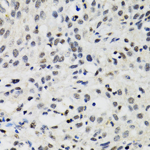 Immunohistochemistry of paraffin-embedded Human lung cancer using SMARCAD1 Polyclonal Antibody at dilution of 1:100 (40x lens) .